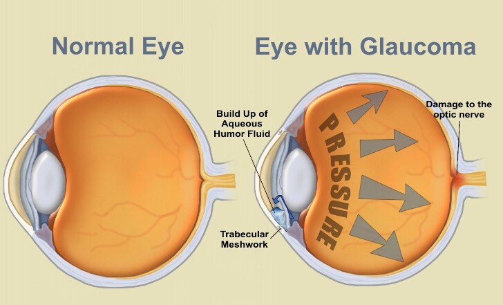 Glaucoma Eye