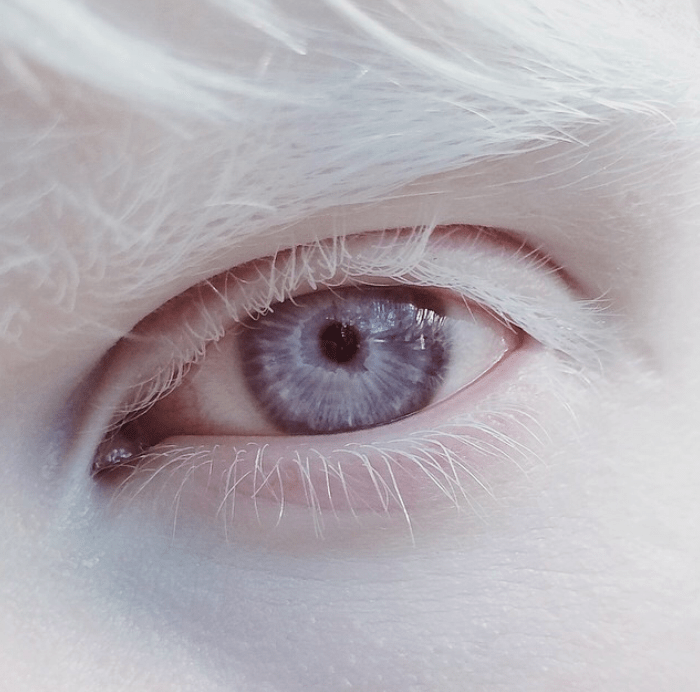 What Is Albinism Zoomax Low Vision Aids