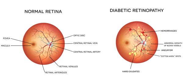 diabetic retinopathy