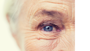 Aged-related macular degeneration