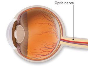 Optic nerve can cause low vision