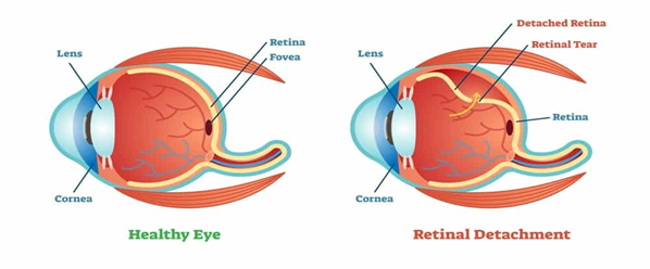 Figure 1: Retinal Detachment Condition 