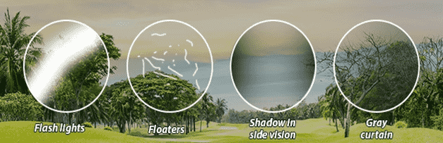 Figure 3:Symptoms of retinal detachment