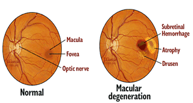 macular degeneration