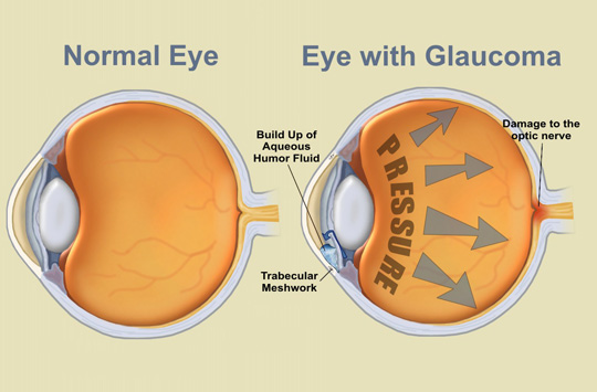 primary open angle glaucoma