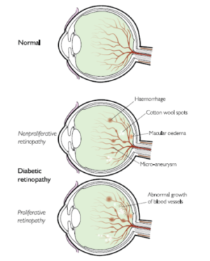 low vision sympotoms caused by dr