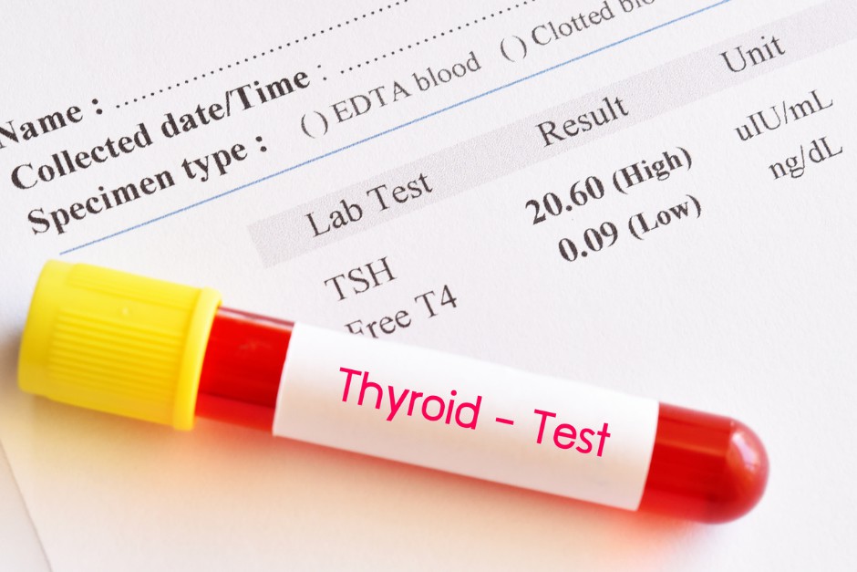 causes of thyroid eye disease