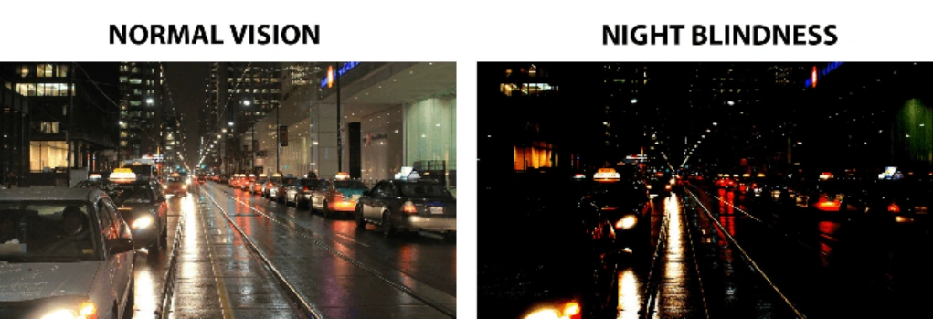 night blindness (nyctalopia)