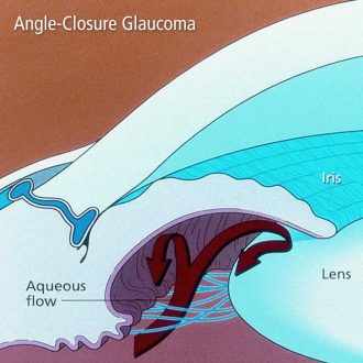 Acute angle-closure glaucoma acute angle closure glaucoma
